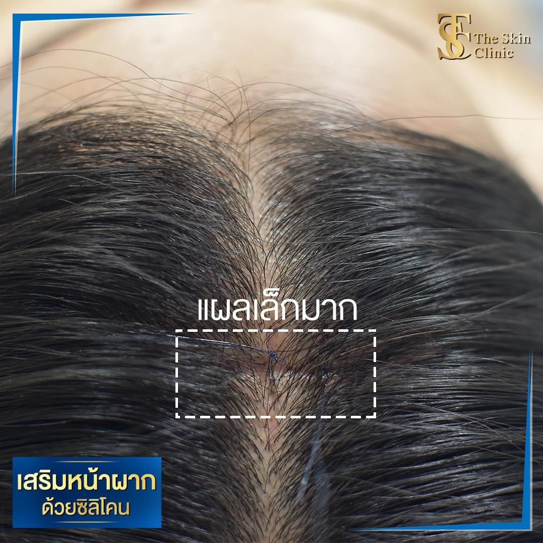 ซิลิโคนหน้าผาก ๑๙๐๕๓๐ 0002